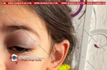 Ահազանգ SHAMSHYAN.com-ին. 4-ամյա երեխայի մայրը բարձրաձայնում է՝ երեխան «Մեգամոլ»-ում մետաղյա ձողով վնասել է աչքը, պատճառը տեղի անվտանգության կանոնների բացակայությունն է. ՖՈՏՈՌԵՊՈՐՏԱԺ, ՏԵՍԱՆՅՈՒԹ , ԼՐԱՑՎԱԾ